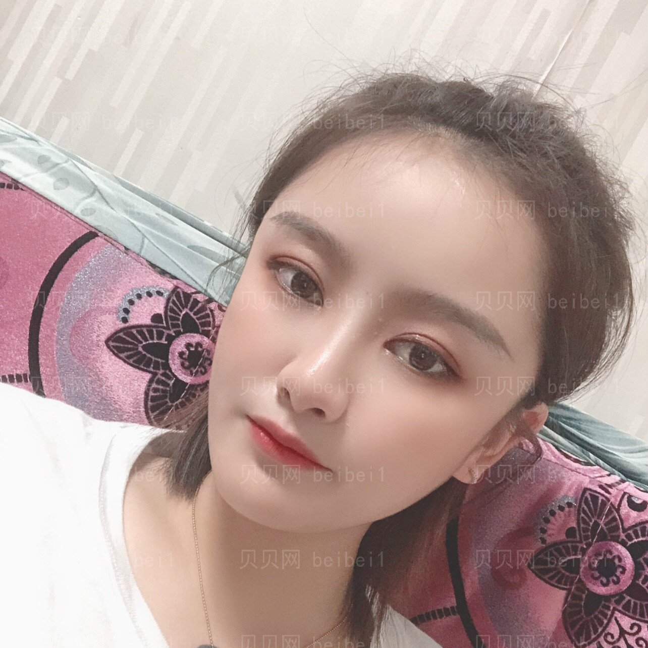 重庆郑荃丽格医疗美容刘永涛切开双眼皮介绍