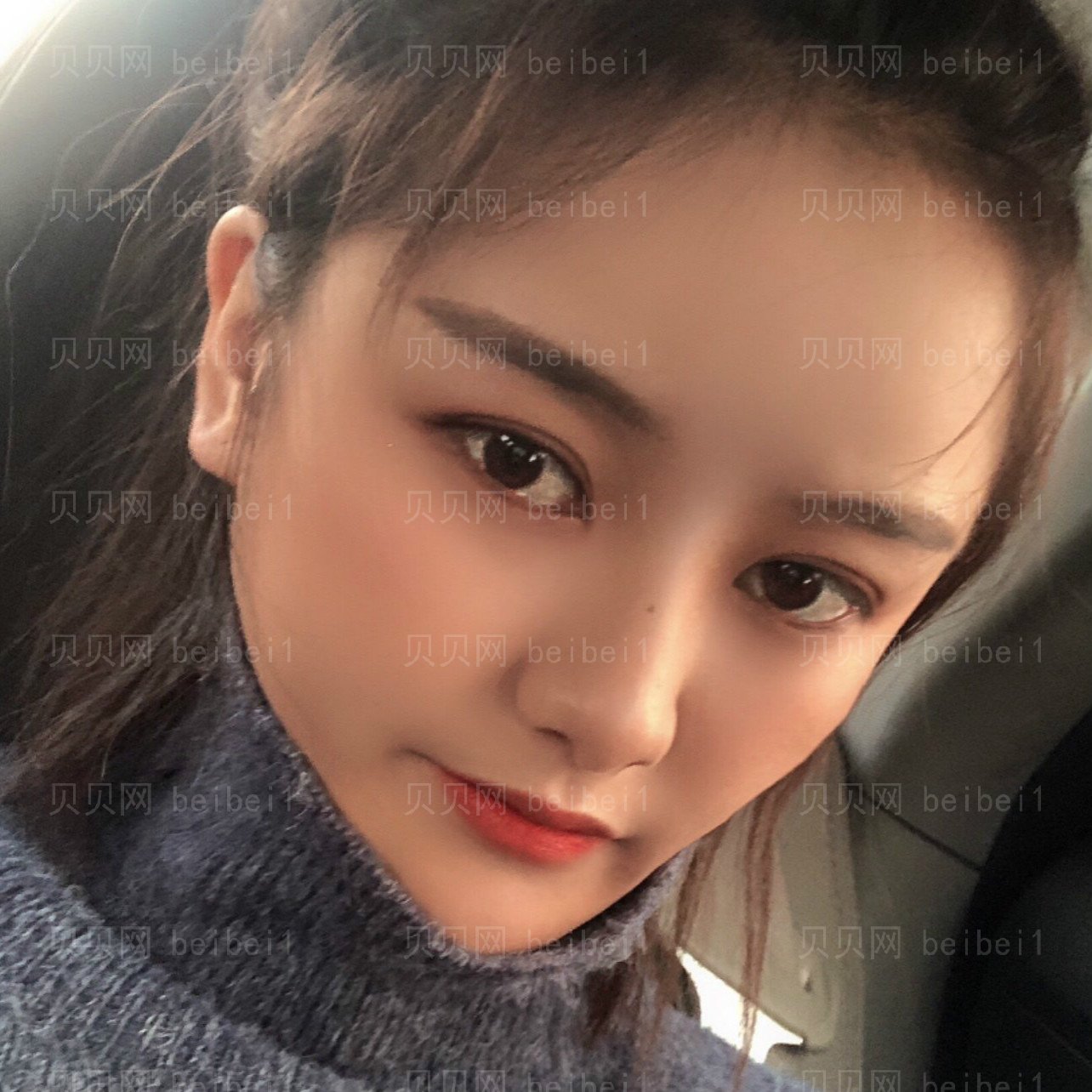 重庆郑荃丽格医疗美容刘永涛切开双眼皮介绍