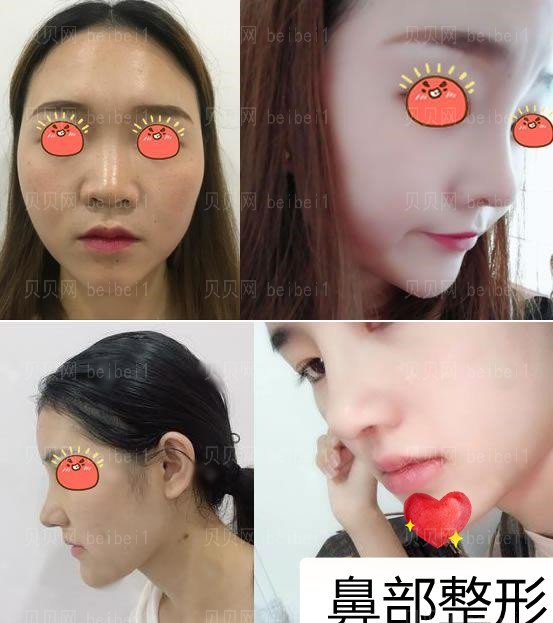 八大处整形外科隆鼻哪位专家做的好？鼻子介绍查询分享