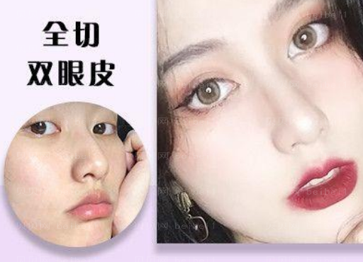 广医二院双眼皮多少钱？较新一览