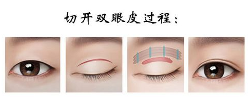 广医二院双眼皮多少钱？较新一览