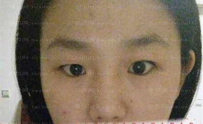 九院张余光双眼皮怎么样