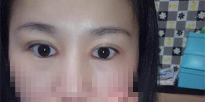 九院张余光双眼皮怎么样