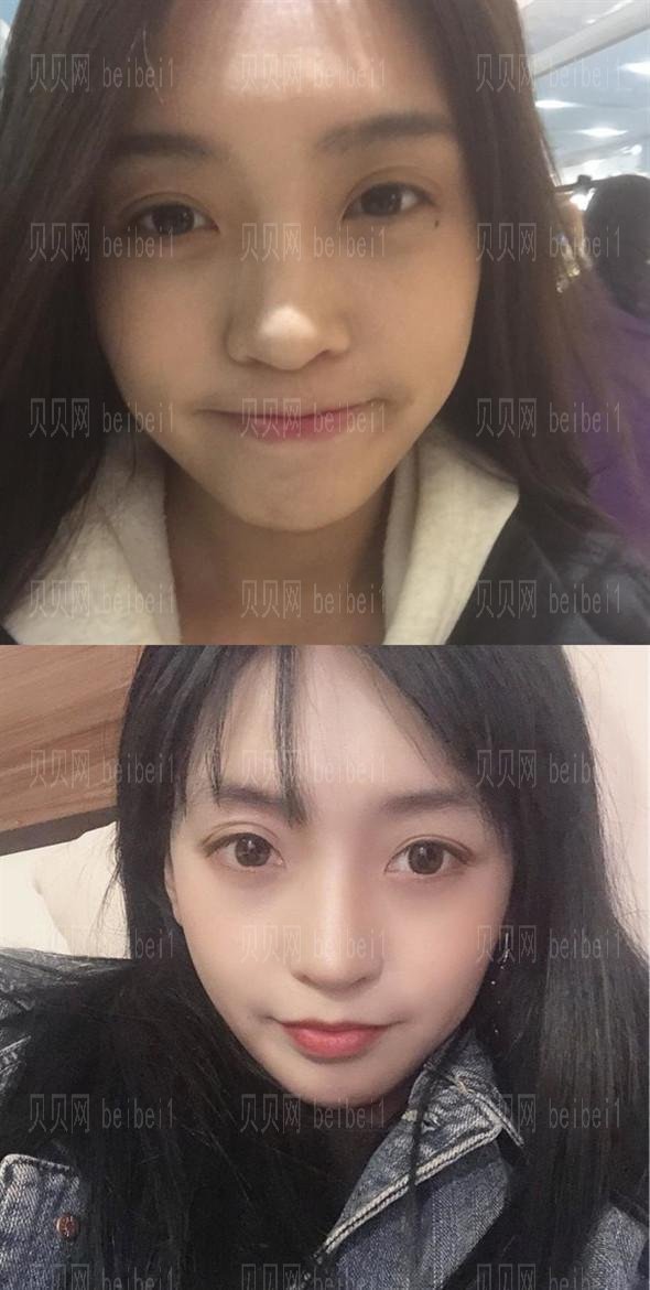 牛永敢做鼻子多少钱?隆鼻价格贵不贵