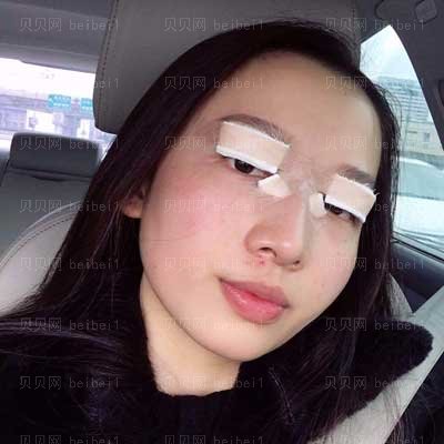 台州中心医院双眼皮价格多少钱？黄卫平收费贵吗？技术怎么样？