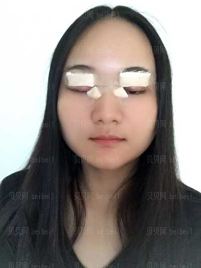 沈阳中国医科大学附属第一医院整形科双眼皮做的怎么样