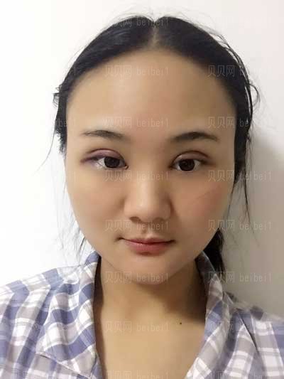 沈阳中国医科大学附属第一医院整形科双眼皮做的怎么样
