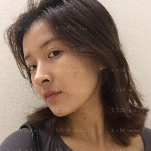 重庆艺星整形医院赵莉光子嫩肤介绍
