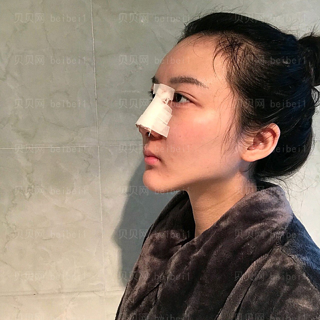 重庆瑞俪医疗美容李光强隆鼻介绍