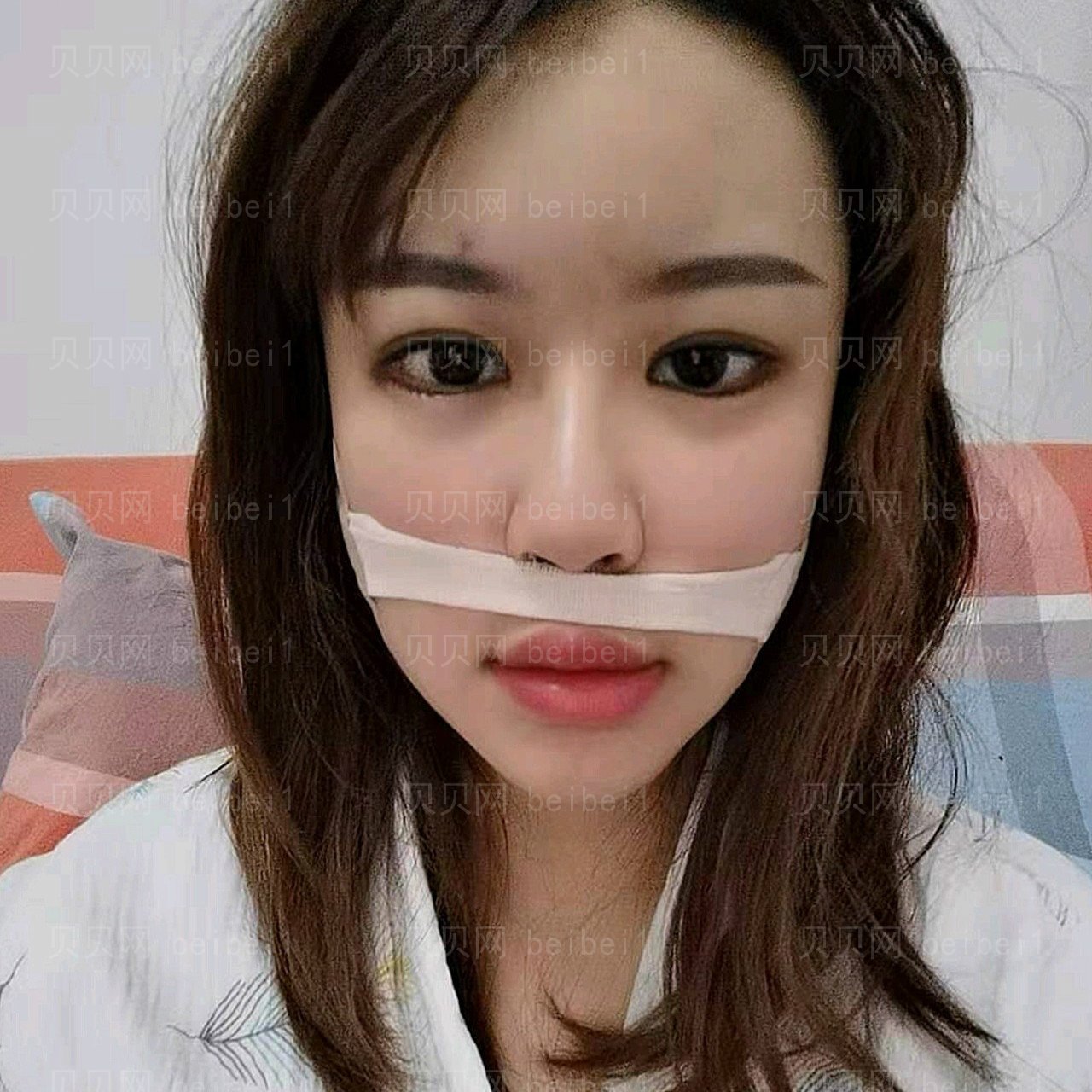 重庆瑞俪医疗美容王润芝假体隆鼻介绍