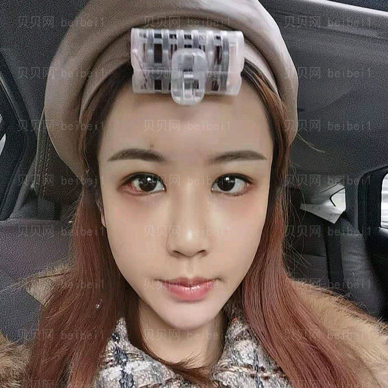 重庆瑞俪医疗美容王润芝假体隆鼻介绍