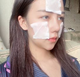 上海时光_宋茂启医生_半肋骨隆鼻_术后果分享~