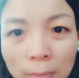 上海时光整形外科医院陶琳埋线提升介绍