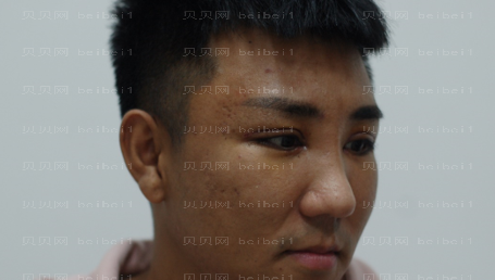 上海时光整形外科医院何晋龙双眼皮修复介绍