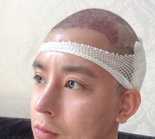 上海时光整形外科医院李桂海头发种植介绍