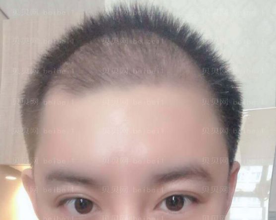上海时光整形外科医院李桂海头发种植介绍