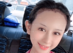 上海时光整形外科医院李桂海头发种植介绍