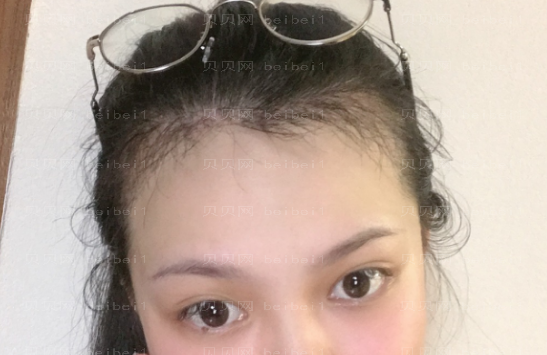 上海时光整形外科医院李桂海植发介绍