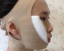 上海时光整形外科医院姚全豊颧骨颧弓整形介绍