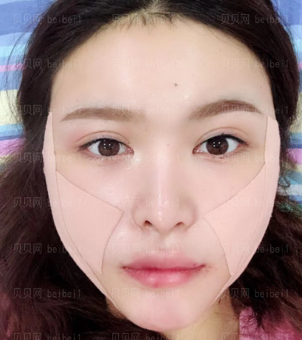 上海时光_姚全豊医生_脸部磨骨_术后果分享~