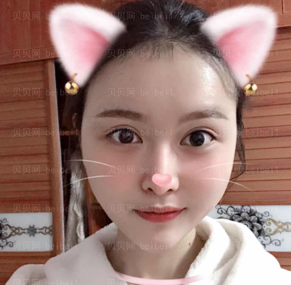 上海时光_姚全豊医生_脸部磨骨_术后果分享~