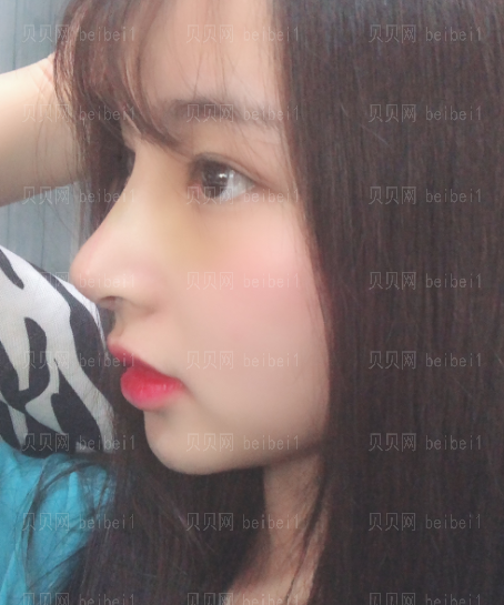 上海华美_张朋医生_鼻头缩小_介绍分享~