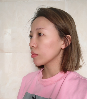 上海华美_张朋医生_半肋骨隆鼻+自体脂肪填充_介绍分享~