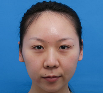 上海翔茂医疗美容门诊部赖仕原眼线修复介绍