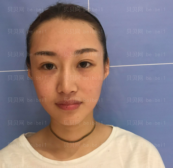 上海时光_刘佳东医生_埋线提升介绍分享!