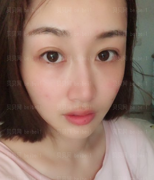 上海时光_刘佳东医生_埋线提升介绍分享!