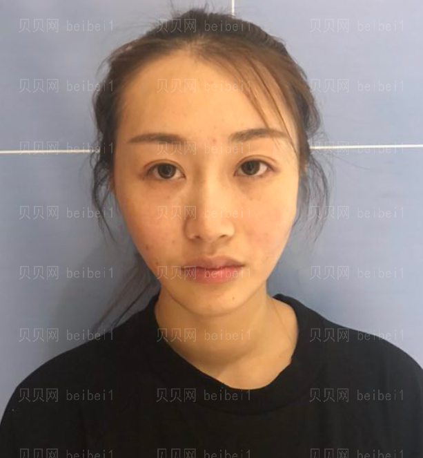 上海时光_刘佳东医生_埋线提升介绍分享!