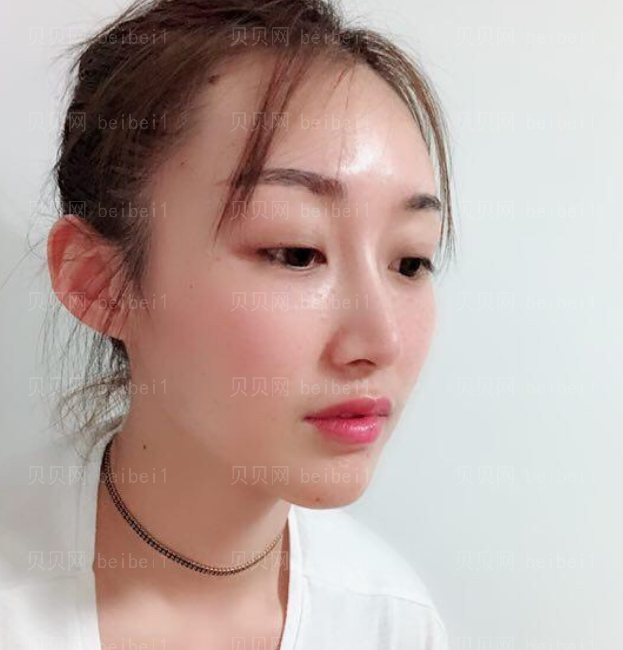 上海时光_刘佳东医生_埋线提升介绍分享!