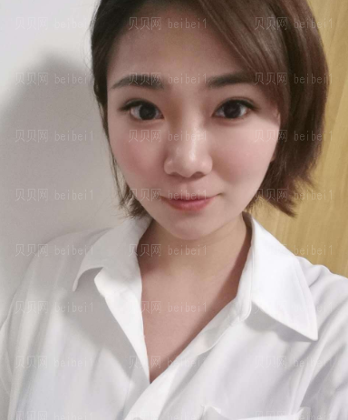 上海时光_张晶医生_开眼角+全切双眼皮+上睑提肌_介绍分享!