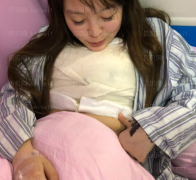 上海时光整形外科医院郑志玉胸部下垂矫正介绍