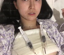 上海时光整形外科医院郑志玉假体隆胸介绍