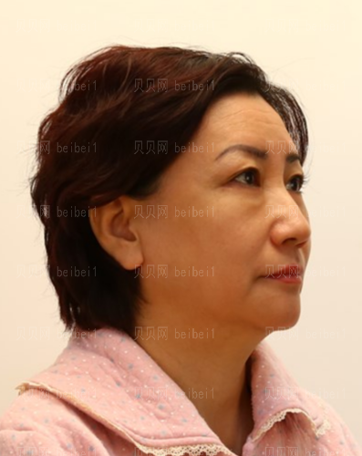上海和睦家整形医院陈磊电波拉皮介绍