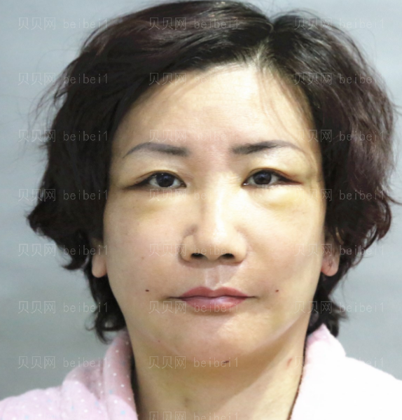 上海和睦家整形医院陈磊电波拉皮介绍