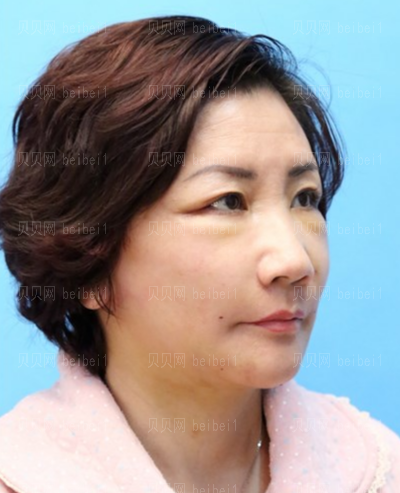 上海和睦家整形医院陈磊电波拉皮介绍