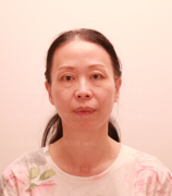 上海和睦家整形医院陆毅电波拉皮介绍