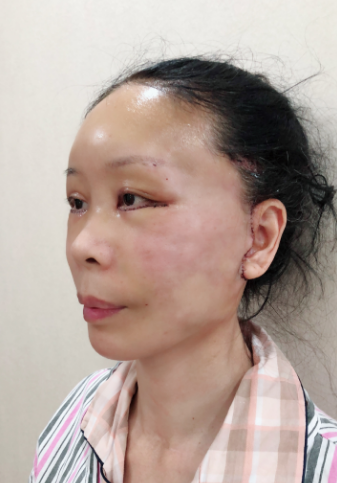 上海和睦家整形医院陆毅电波拉皮介绍