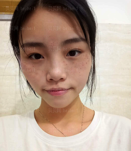 上海和睦家整形医院陆毅彩光祛斑介绍