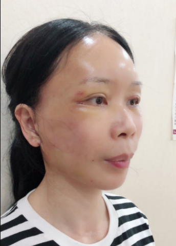 上海和睦家整形医院陆毅电波拉皮介绍