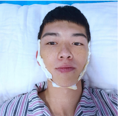 广州华美医疗美容整形医院王洪勇面部吸脂介绍