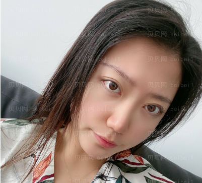 广州华美医疗美容整形医院王洪勇双眼皮介绍