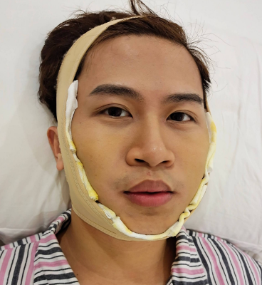 广州华美医疗美容整形医院王洪勇全脸磨骨介绍