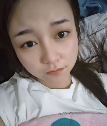 上海华美_谢卫国医生_硅胶隆鼻_分享！