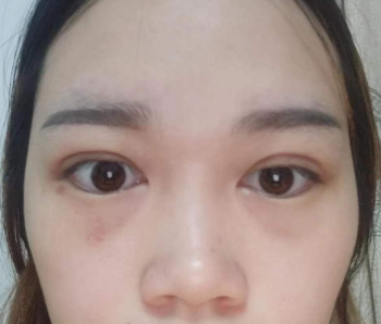 上海华美_徐文龙医生_全切双眼皮+上睑提肌_介绍分享!