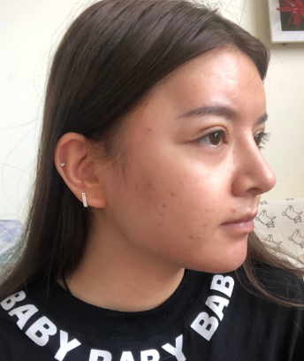 上海华美医疗美容医院杨亚益双眼皮修复介绍