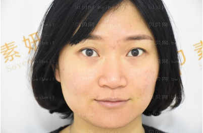 广州华美医疗美容整形医院赵晶晶除皱瘦脸介绍
