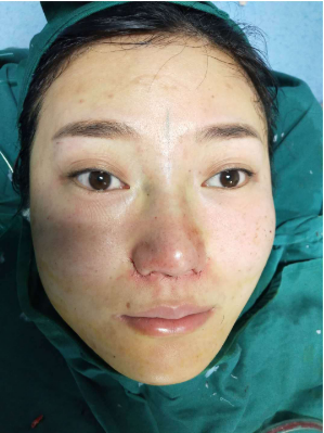 广州华美医疗美容整形医院赵晶晶除皱瘦脸介绍